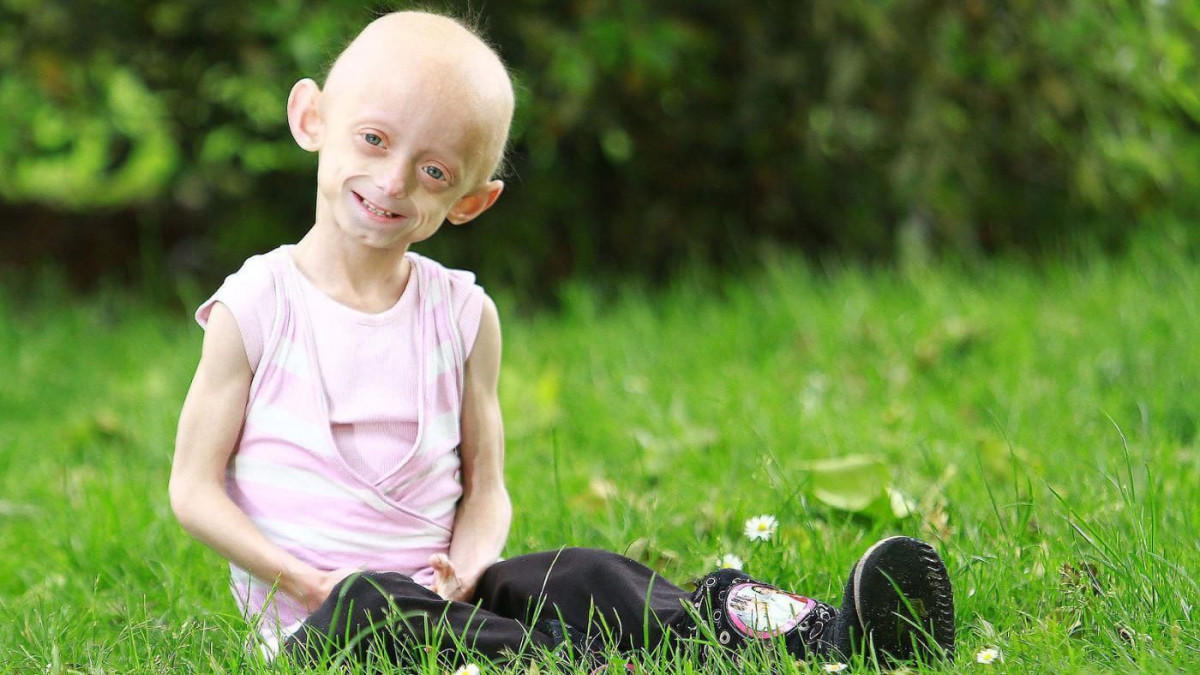 Sindrom Progeria